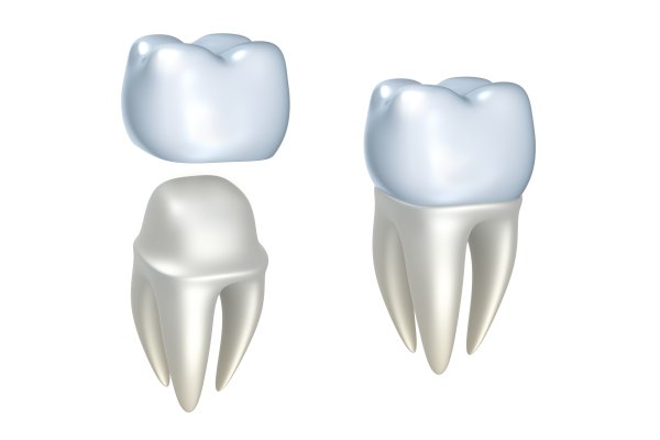The Dental Crown Process: Repairing Teeth