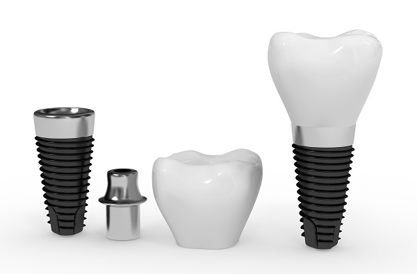 Dental Implants Rowley, MA