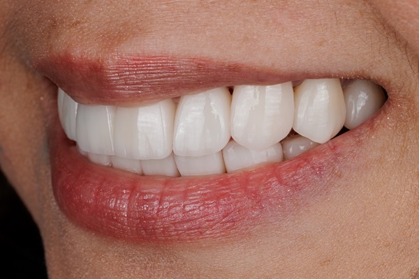 Maintenance Tips For Your Dental Veneers