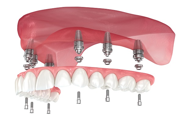Implant Supported Dentures Rowley, MA